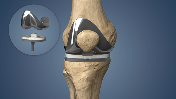 Knee Replacement New Jersy