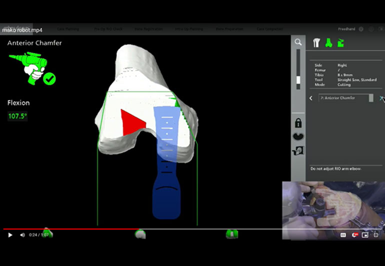 navigation-total-knee