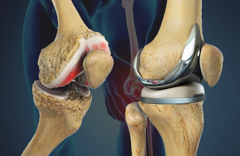 Knee Replacement New Jersy